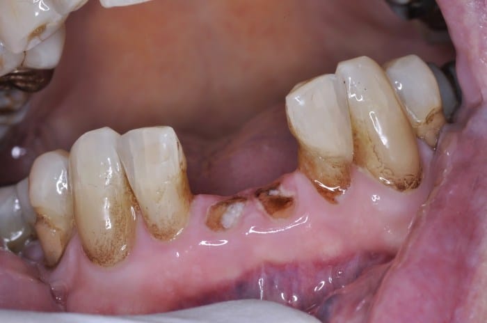root tip removal covered by dental insurance