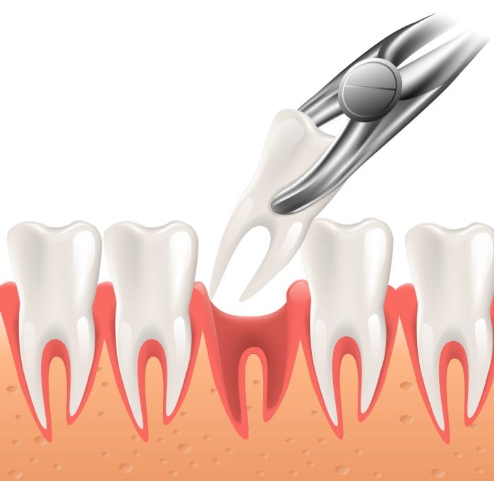 root tip removal covered by dental insurance terbaru